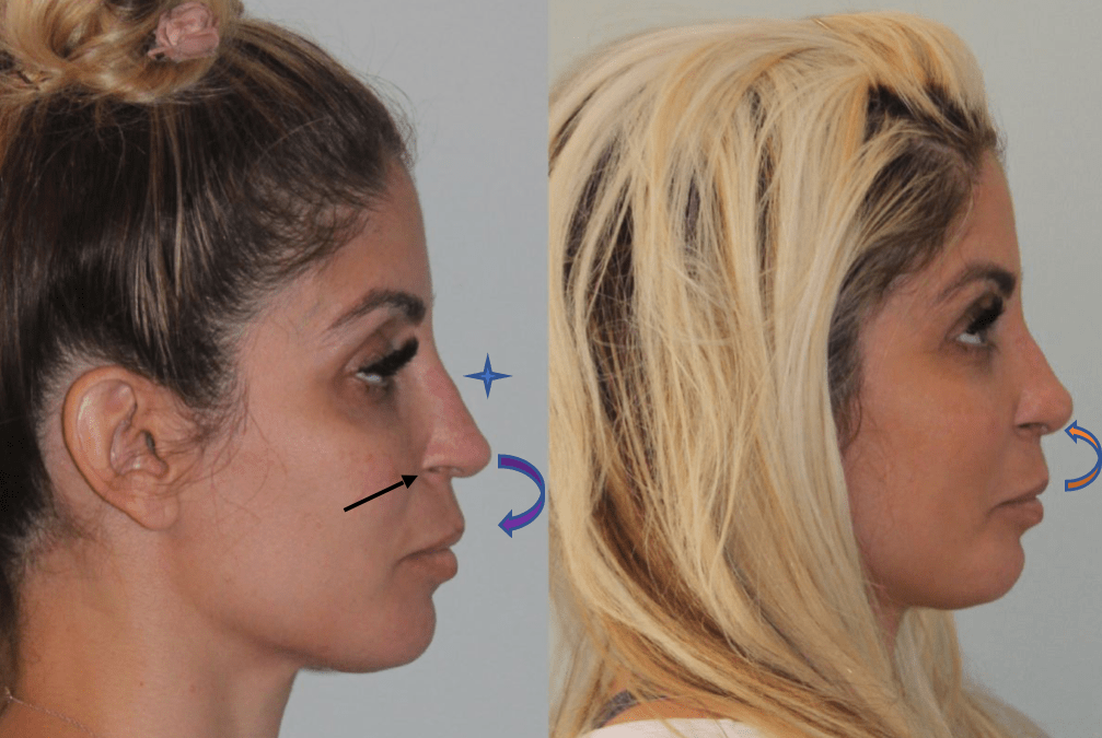 Revision Rhinoplasty Before and After