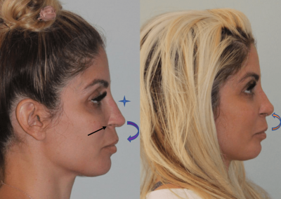 Revision Rhinoplasty Before and After