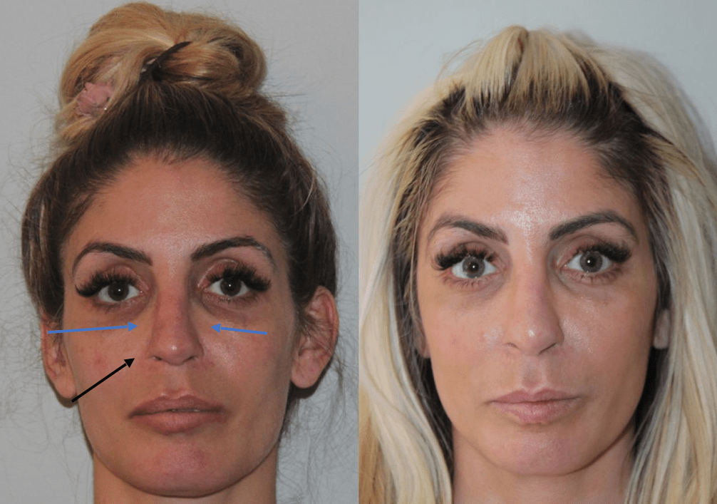 Revision Rhinoplasty Before and After Revision Rhinoplasty Before and After