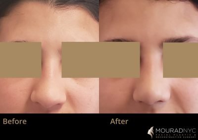 Teenage Rhinoplasty Before and After