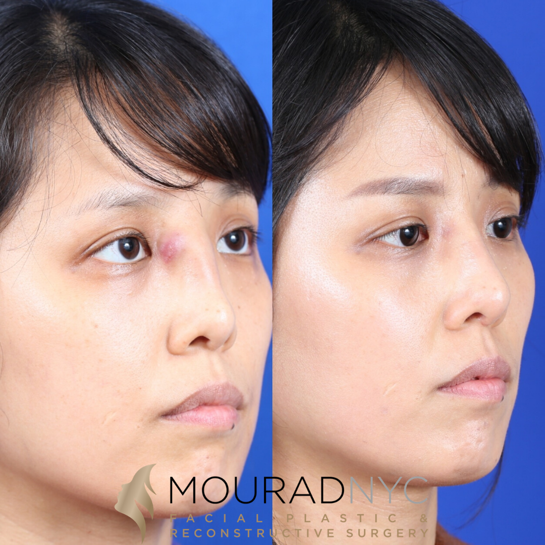 Female Ethnic Revision Rhinoplasty Before and After Female Ethnic Revision Rhinoplasty Before and After
