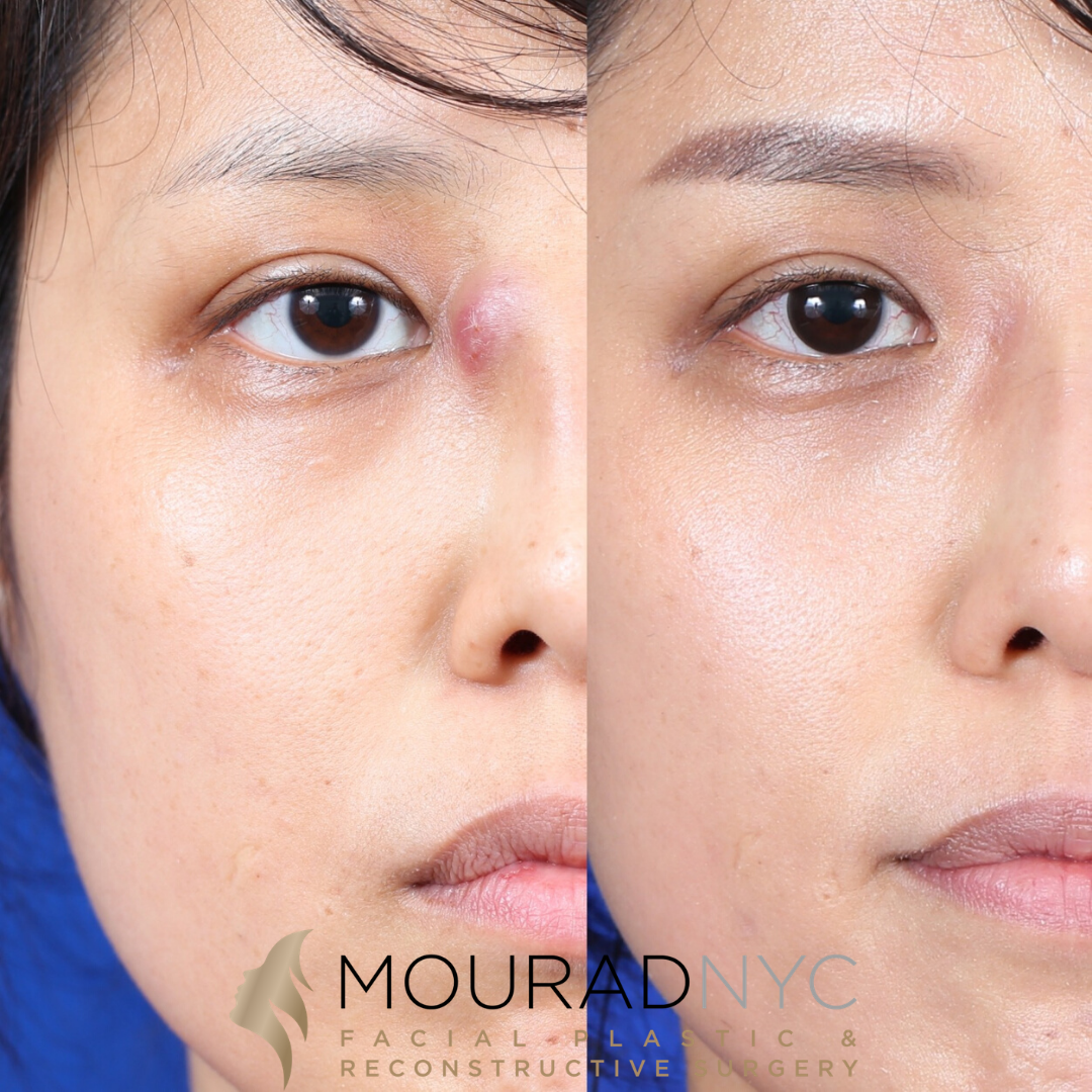 Female Ethnic Revision Rhinoplasty Before and After Female Ethnic Revision Rhinoplasty Before and After