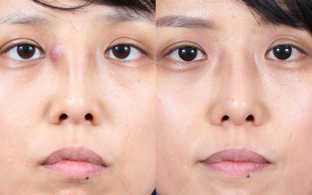 Female Ethnic Revision Rhinoplasty Before and After