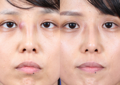 Female Ethnic Revision Rhinoplasty Before and After