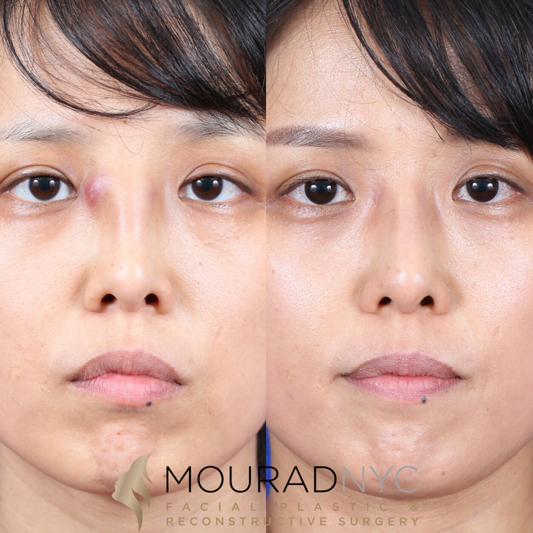 Female Ethnic Revision Rhinoplasty Before and After Female Ethnic Revision Rhinoplasty Before and After