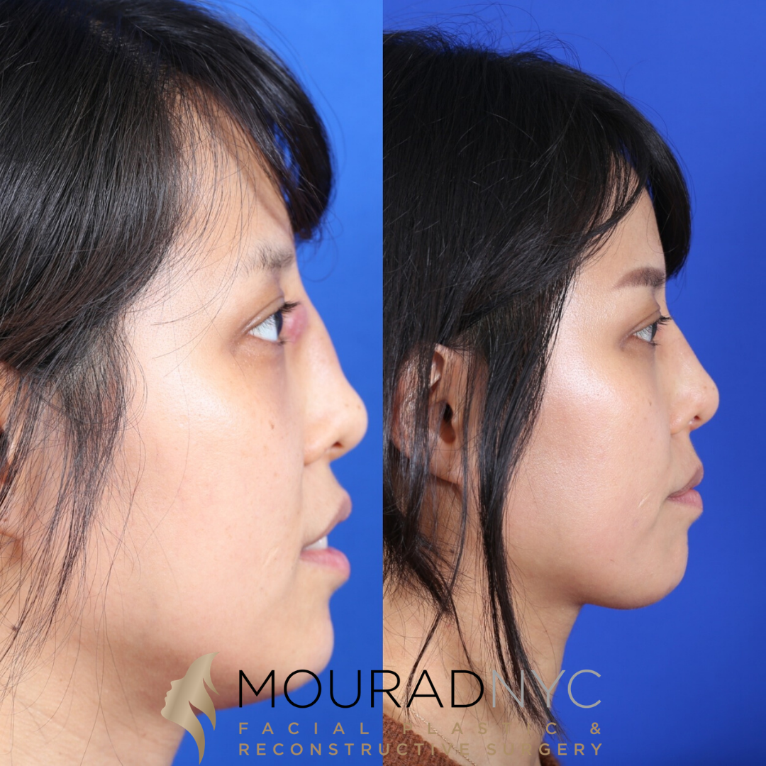 Female Ethnic Revision Rhinoplasty Before and After Female Ethnic Revision Rhinoplasty Before and After
