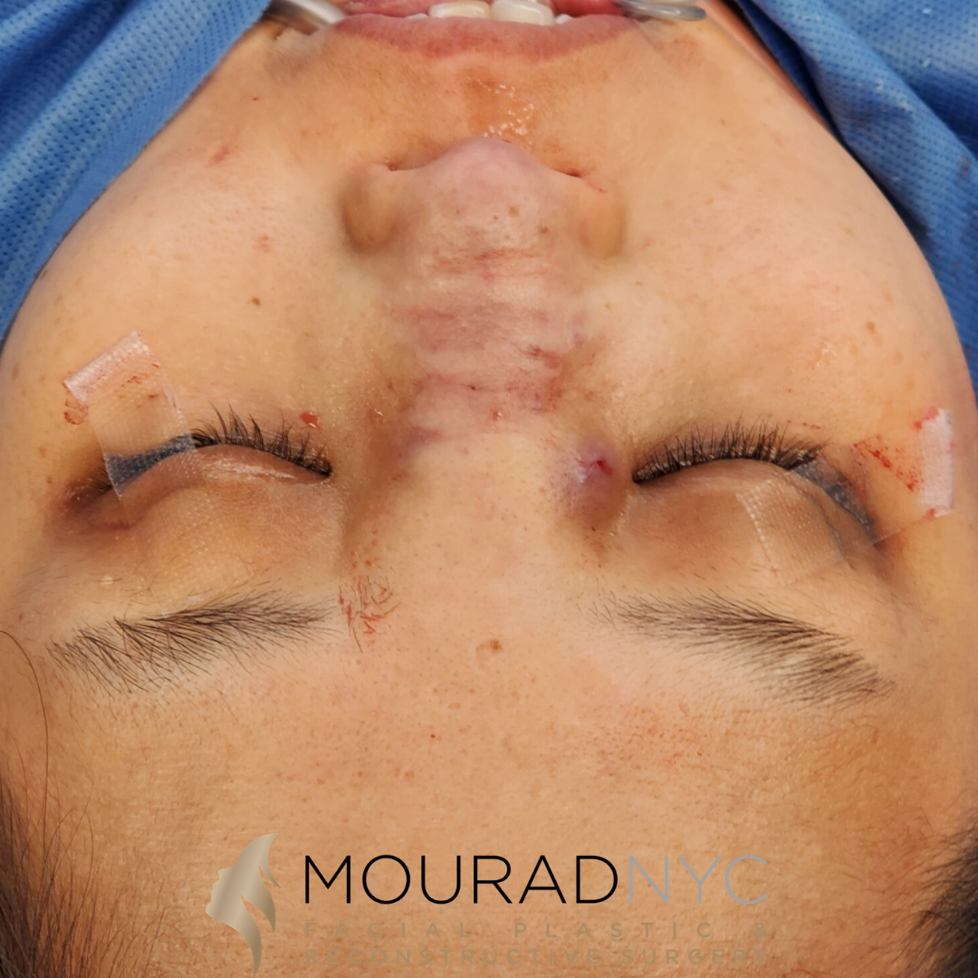 Female Ethnic Revision Rhinoplasty Before and After Female Ethnic Revision Rhinoplasty Before and After