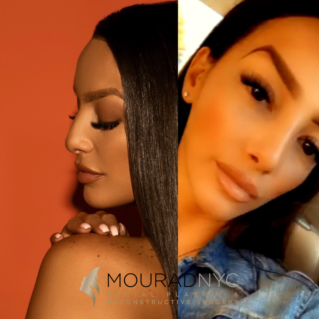 Female Ethnic Rhinoplasty Female Ethnic Rhinoplasty