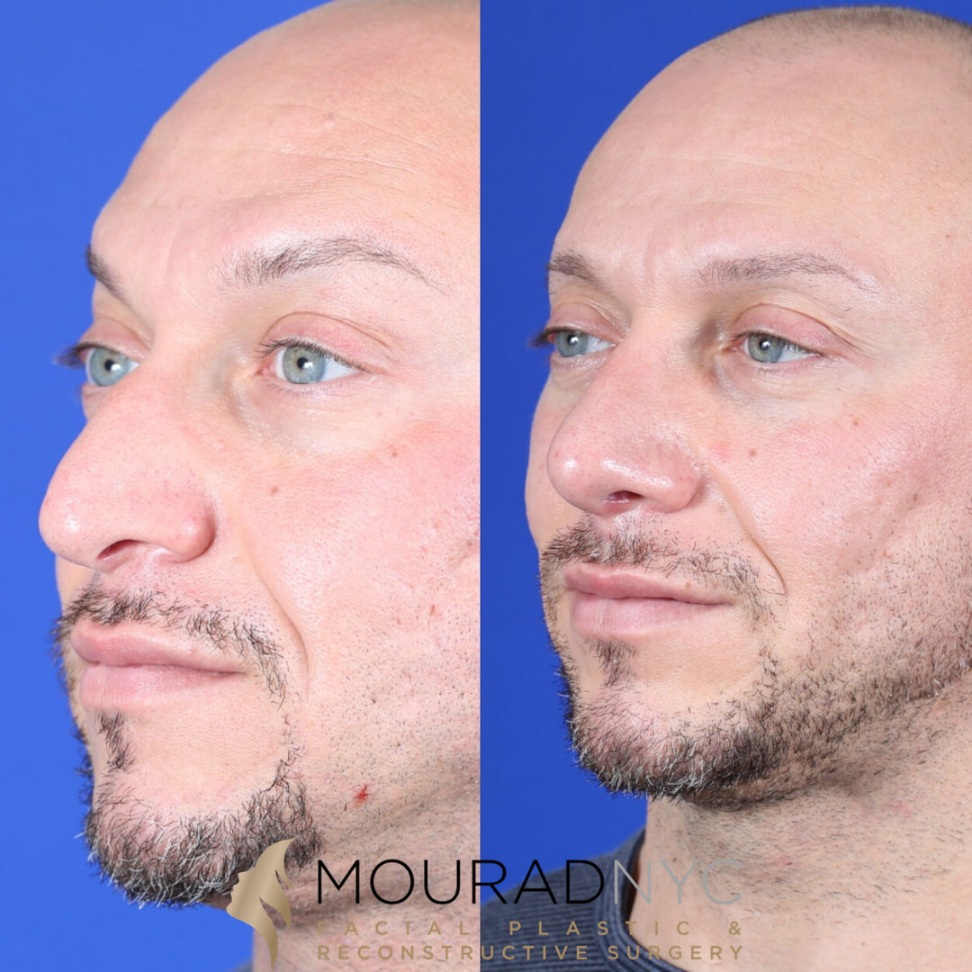 Male Deviated Septum / Rhinoplasty Before and After Male Deviated Septum / Rhinoplasty Before and After