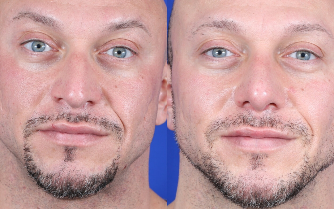 Male Deviated Septum / Rhinoplasty Before and After