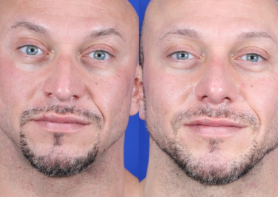Male Deviated Septum / Rhinoplasty Before and After
