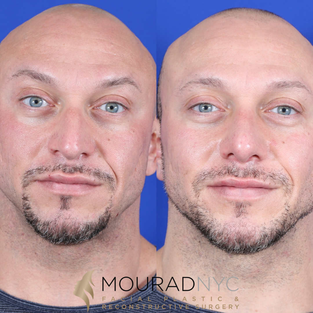 Male Deviated Septum / Rhinoplasty Before and After Male Deviated Septum / Rhinoplasty Before and After