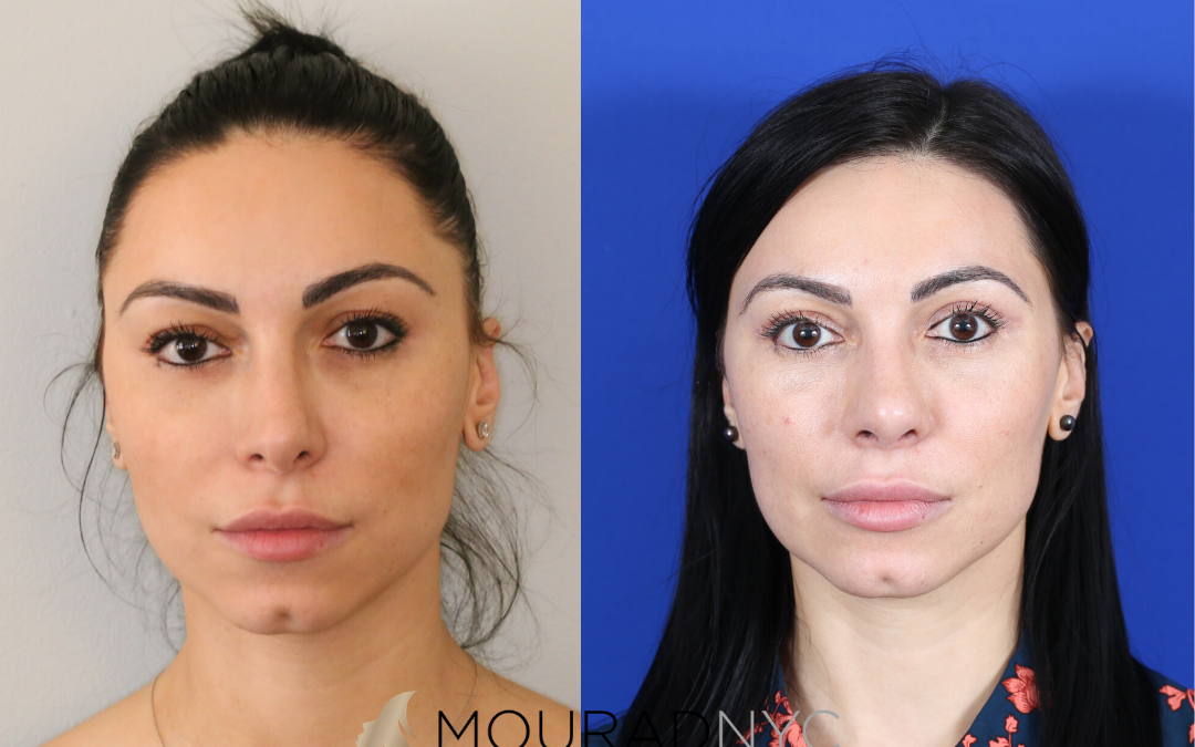 Blepharoplasty Before and After