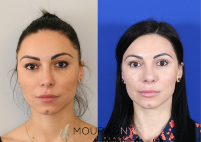 Blepharoplasty Before and After