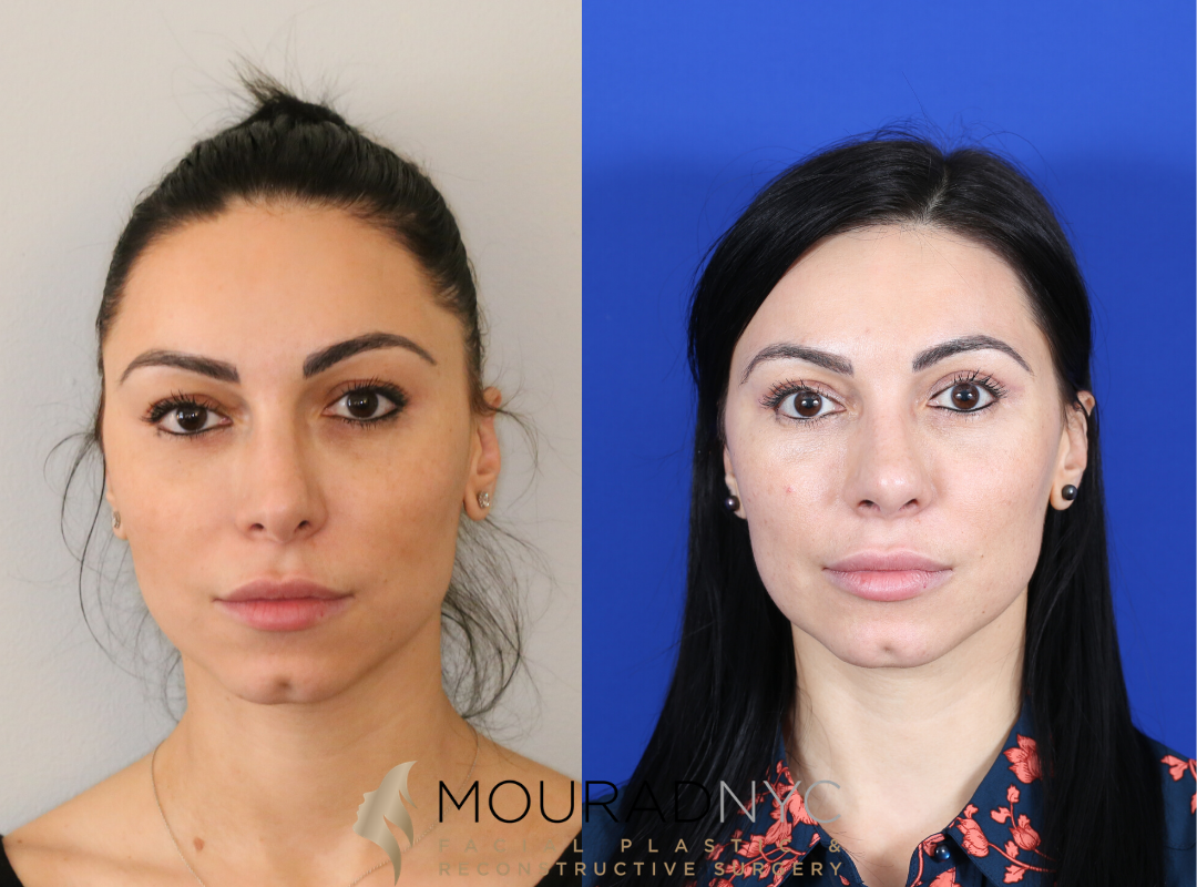 Blepharoplasty Before and After