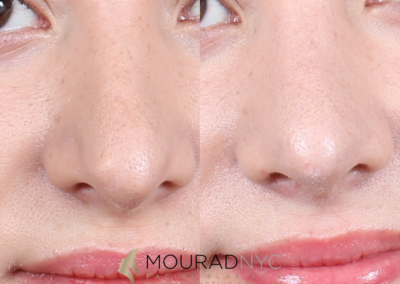 Female Revision Rhinoplasty Before and After