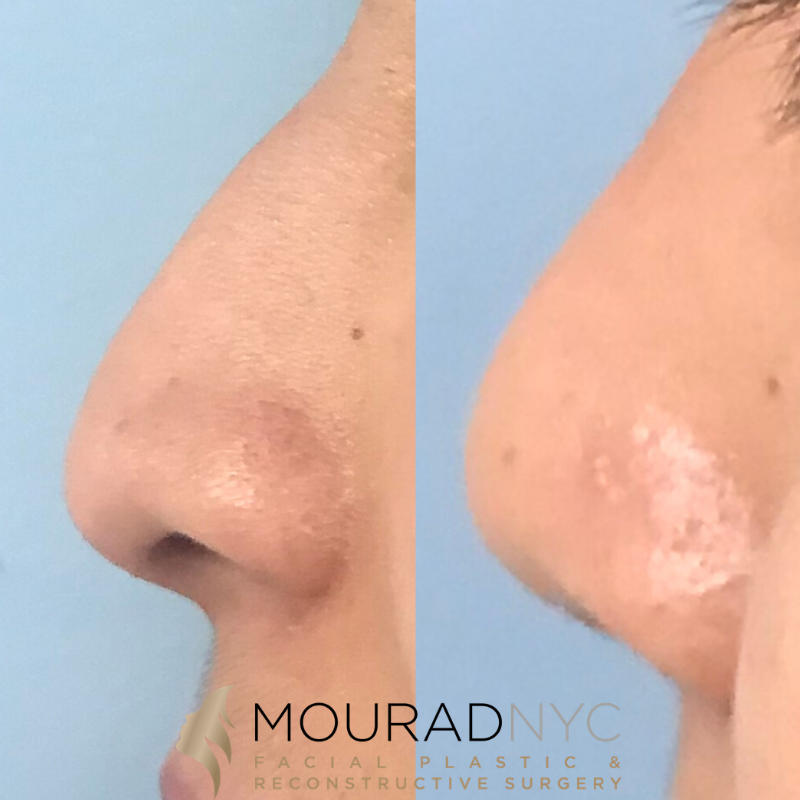 Female Ethnic Rhinoplasty Before and After Female Ethnic Rhinoplasty Before and After