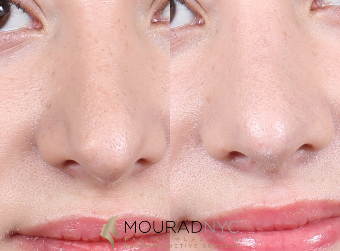 Female Revision Rhinoplasty Before and After