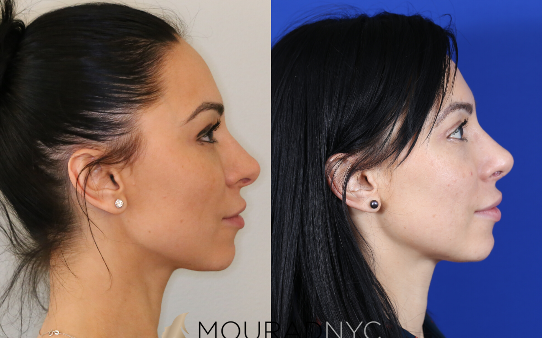 Revision Rhinoplasty Before and After