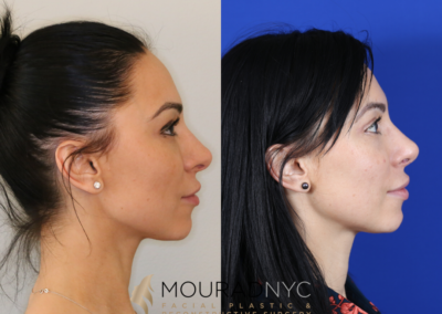 Revision Rhinoplasty Before and After