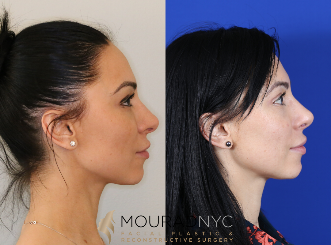 Revision Rhinoplasty Before and After Revision Rhinoplasty Before and After