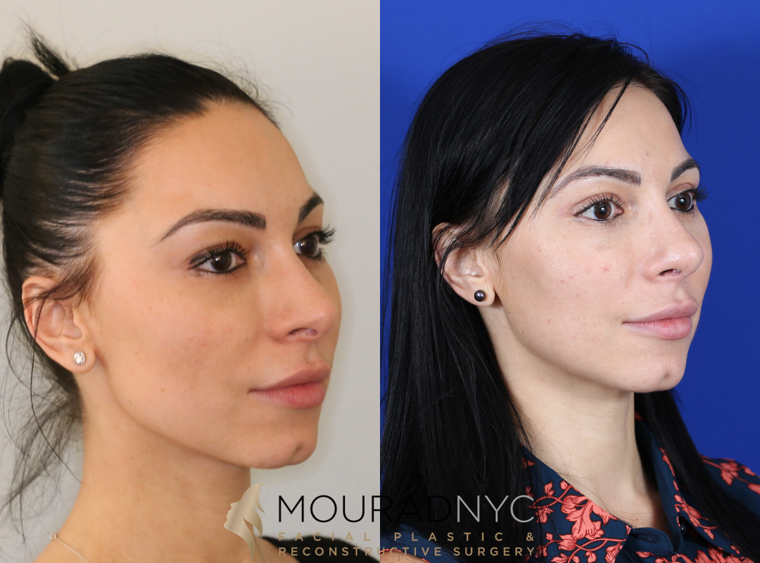 Revision Rhinoplasty Before and After Revision Rhinoplasty Before and After