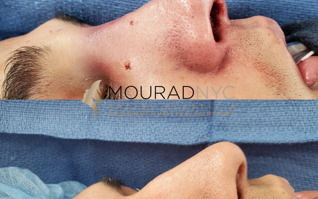 Closed Rhinoplasty