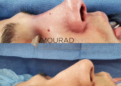 Closed Rhinoplasty