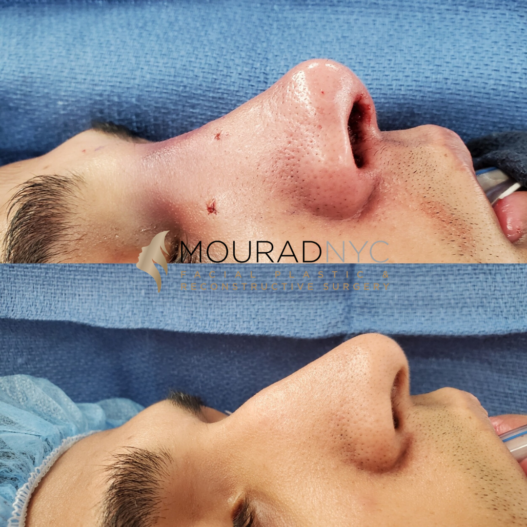 Closed Rhinoplasty Closed Rhinoplasty