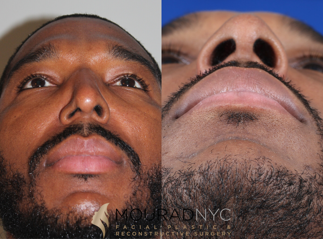 Male Ethnic Rhinoplasty Before and After Male Ethnic Rhinoplasty Before and After