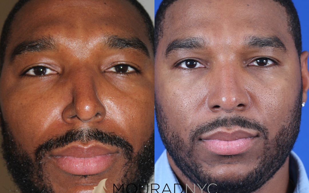 Male Ethnic Rhinoplasty Before and After