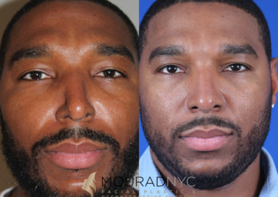 Male Ethnic Rhinoplasty Before and After