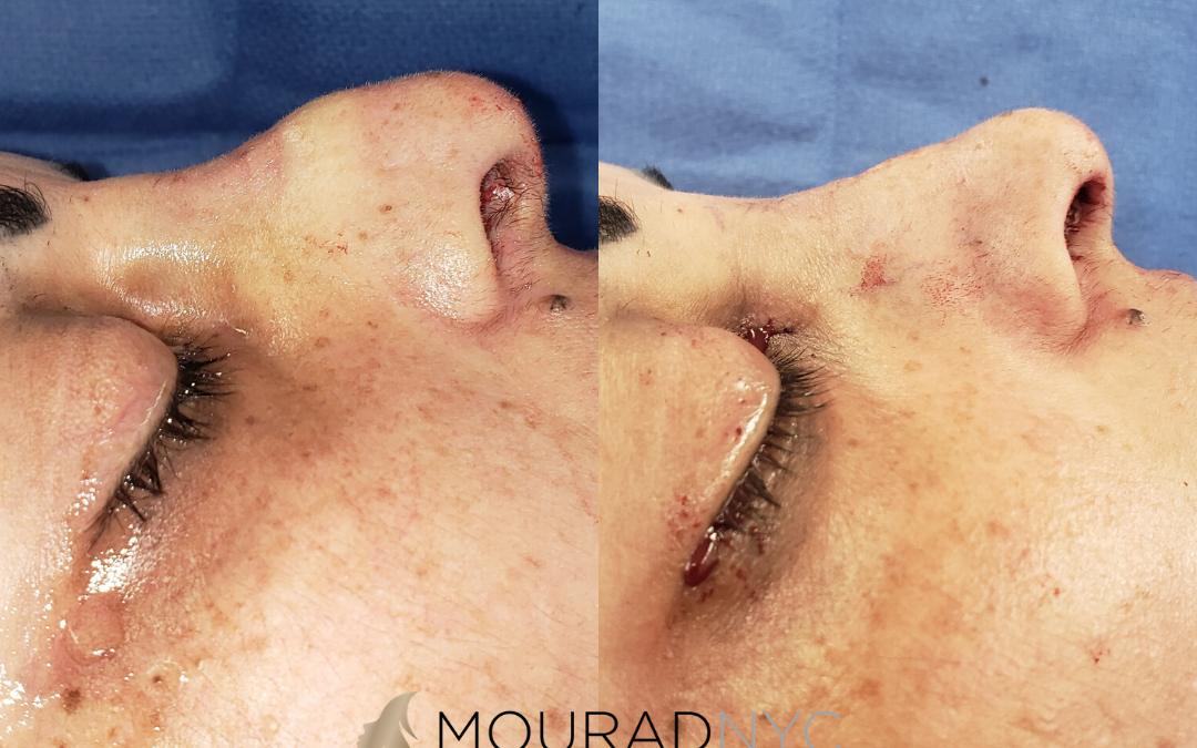 Female Ethnic Rhinoplasty Before and After