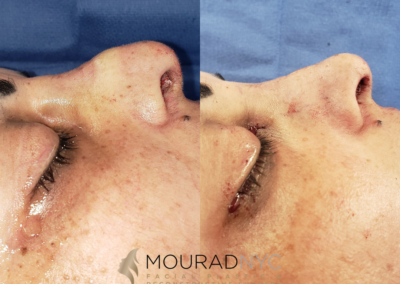 Female Ethnic Rhinoplasty Before and After