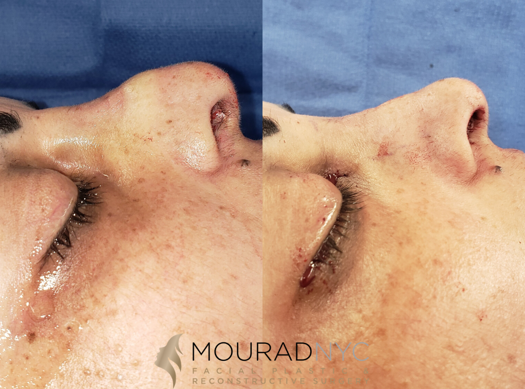 Female Ethnic Rhinoplasty Before and After Female Ethnic Rhinoplasty Before and After