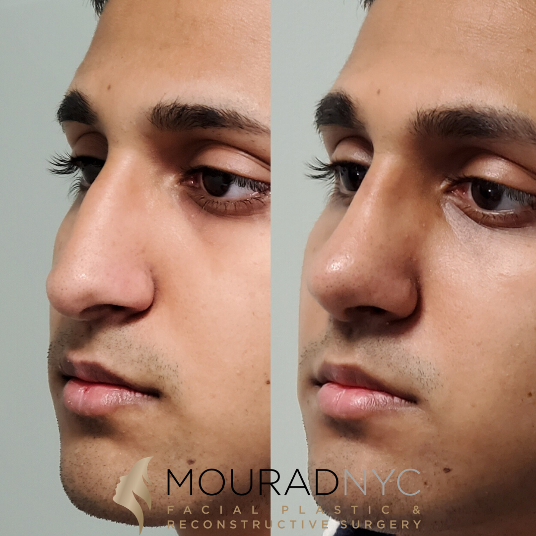 Male Closed Rhinoplasty Male Closed Rhinoplasty