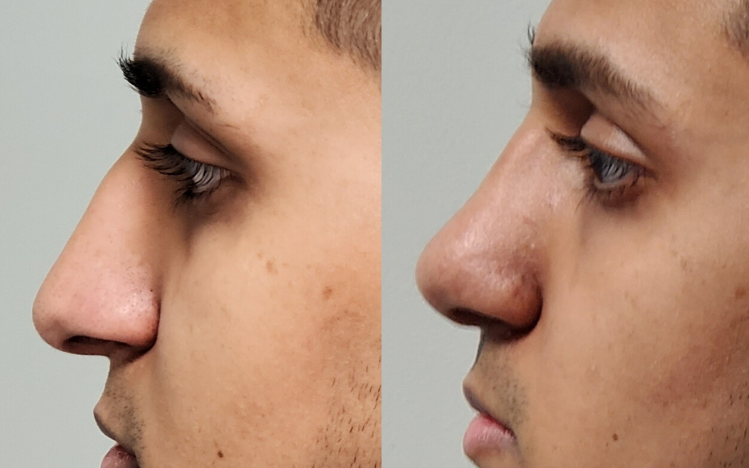 Male Closed Rhinoplasty
