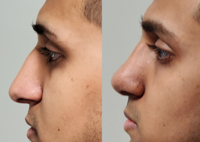 Male Closed Rhinoplasty