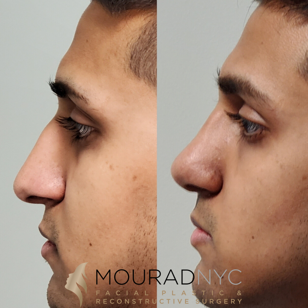 Male Closed Rhinoplasty Male Closed Rhinoplasty