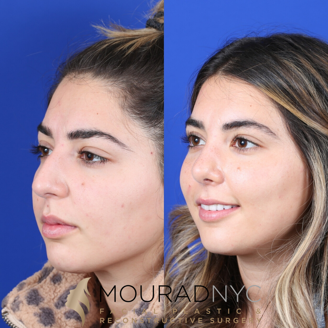 Female Revision Rhinoplasty 4 Months Before and After Female Revision Rhinoplasty 4 Months Before and After