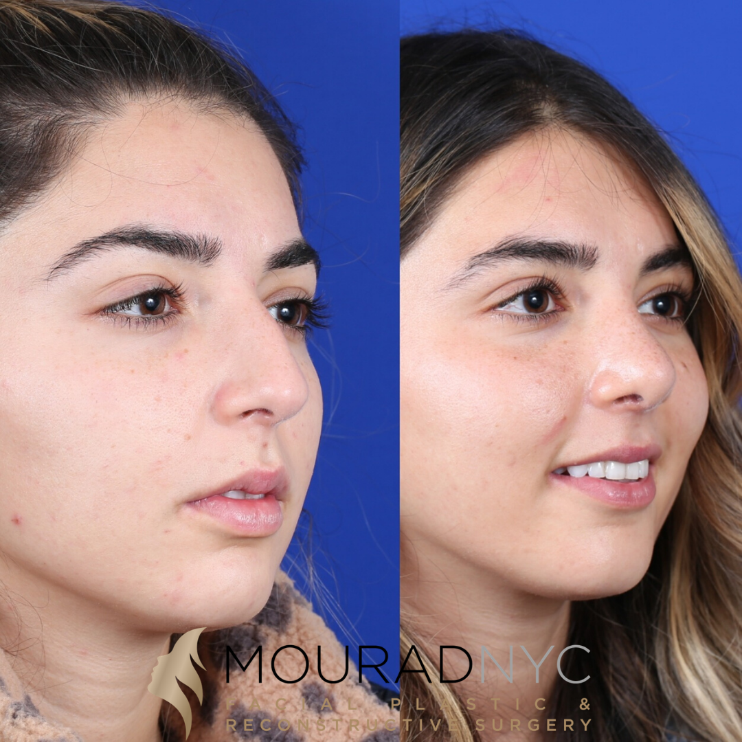 Female Revision Rhinoplasty 4 Months Before and After Female Revision Rhinoplasty 4 Months Before and After
