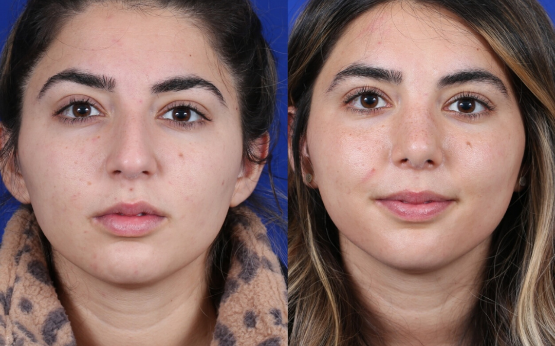Female Revision Rhinoplasty 4 Months Before and After