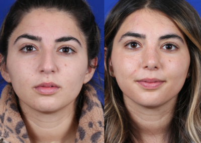 Female Revision Rhinoplasty 4 Months Before and After
