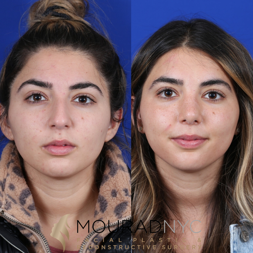 Female Revision Rhinoplasty 4 Months Before and After Female Revision Rhinoplasty 4 Months Before and After