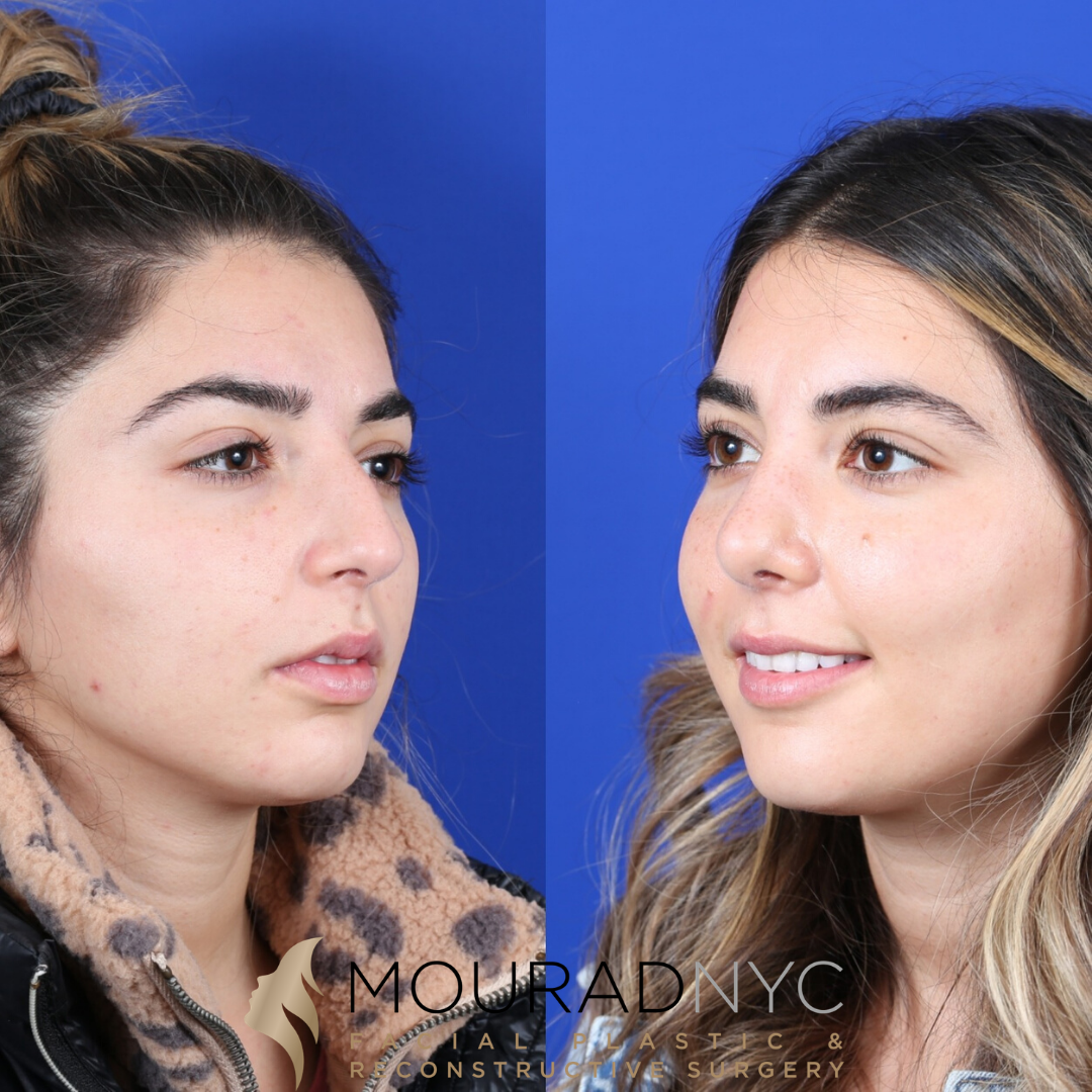 Female Revision Rhinoplasty 4 Months Before and After Female Revision Rhinoplasty 4 Months Before and After