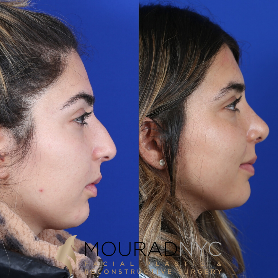 Female Revision Rhinoplasty 4 Months Before and After Female Revision Rhinoplasty 4 Months Before and After