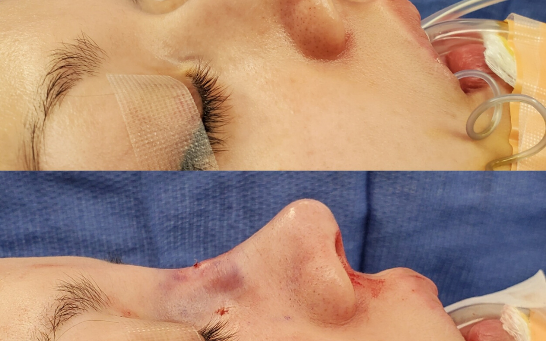 Female Closed Rhinoplasty