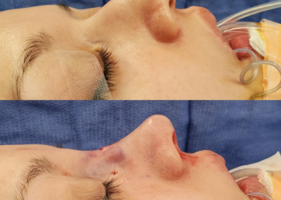 Female Closed Rhinoplasty