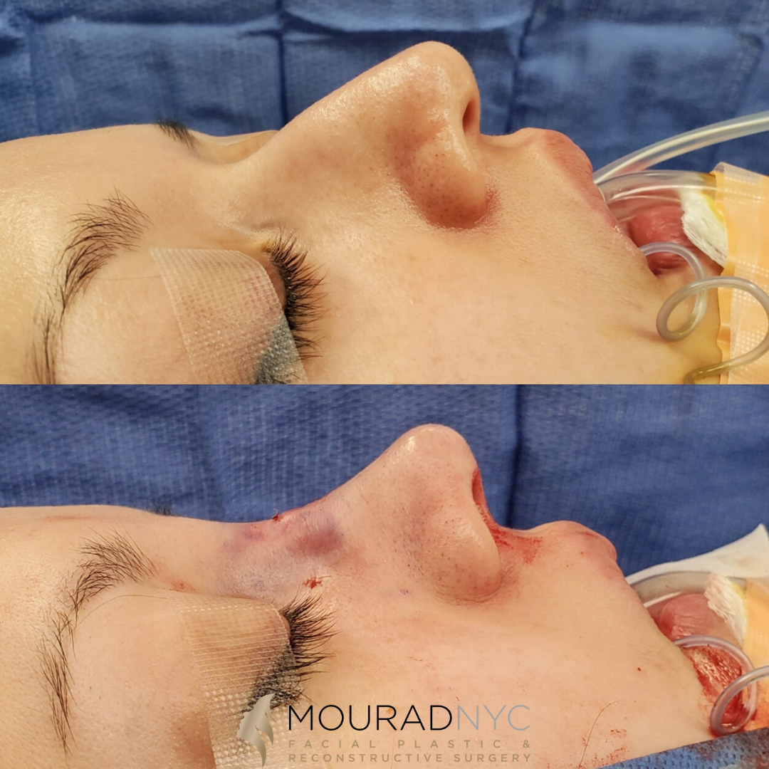 Female Closed Rhinoplasty Female Closed Rhinoplasty