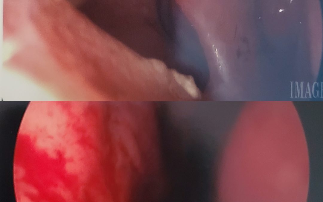 Female Septal Perforation Before and After
